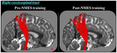 Effect of Neuromuscular Electrical Stimulation Training on the Finger Extensor Muscles for the Contralateral Corticospinal Tract in Normal Subjects: A Diffusion Tensor Tractography Study